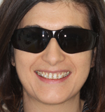 Durchsichtige Brackets