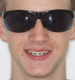 Metallbrackets